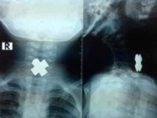 Dị vật trong thực quản - Hình ảnh minh họa